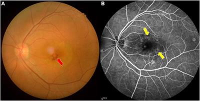 Functional Connectivity Hypointensity of Middle Cingulate Gyrus and Thalamus in Age-Related Macular Degeneration Patients: A Resting-State Functional Magnetic Resonance Imaging Study